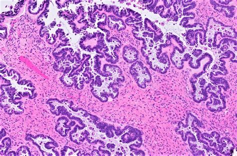 serous borderline tumor pathology outlines
